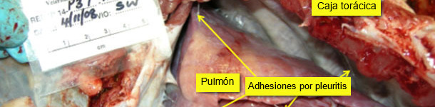 Pericarditis