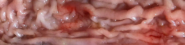 Engrosamiento de la mucosa en parte distal del intestino delgado