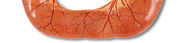 La necropsia de casos de diarrea por ETEC suele mostrar asas del intestino delgado dilatadas, finas y congestionadas, llenas de diarrea acuosa de color amarillo.