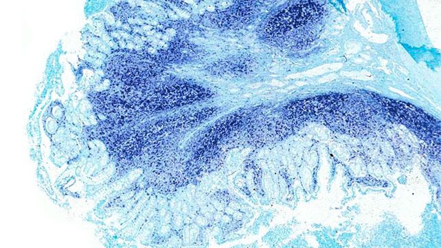 &Iacute;leon. El mismo &iacute;leon del cerdo afectado por enfermedad sist&eacute;mica asociada a PCV2 presenta una gran cantidad de genoma de PCV2 en las placas de Peyer y en la mucosa intestinal. Hibridaci&oacute;n in situ para detectar PCV2; colorante de contraste verde r&aacute;pido.