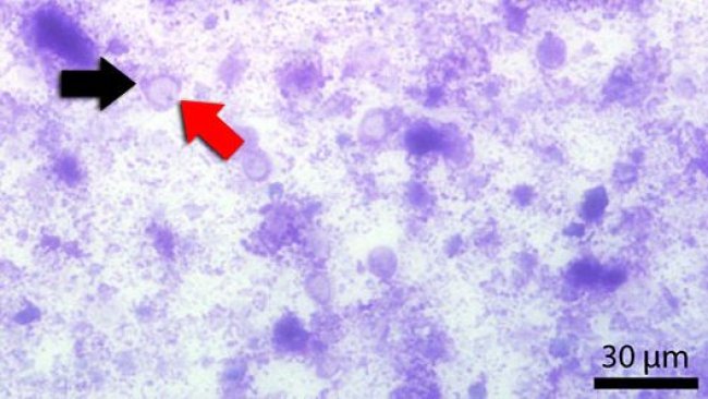 Frotis fecal teñido con Diff-Quick. La flecha roja señala la vacuola central y la negra el núcleo.