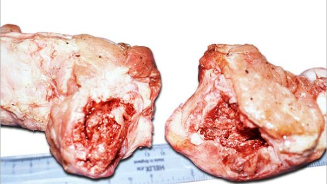 Cabeza del fémur completamente fracturada por la epífisis o debajo de ella mostrando hinchazón alrededor de la fractura debido a periostitis