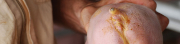 Diarrea neonatal causada por E. Coli. (Cortes&iacute;a Dr Hector Patullo)