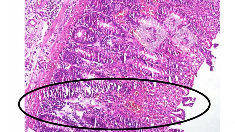 Foto 4. Trombosis vascular, infarto, ulceraci&oacute;n en mucosa del colon.
