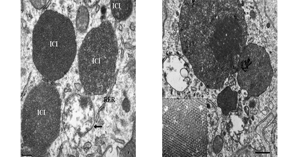 Microscopie &eacute;lectronique d'un ganglion lymphatique d'un porc avec du PCV2-SD. Notez la pr&eacute;sence de corps d'inclusion intra-cytoplasmiques de PCV2 (ICI) ; sur quelques zones, les particules virales peu