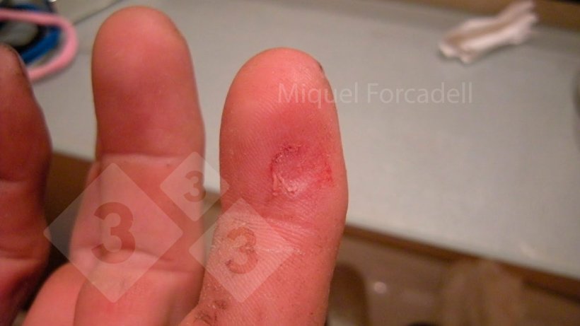 The small, sharp teeth of the piglets can cause these bothersome injuries to the workers' fingers during tooth grinding.
