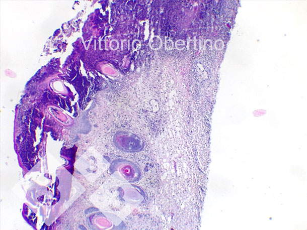 Figure 9. Skin. Focal epithelial erosion in which the superficial layer is replaced by abundant amorphous to granular eosinophilic material with karyorrhectic debris (necrosis) and abundant degenerate, viable neutrophilic granulocytes. Multifocally, the epithelium appears moderately to markedly hyperplastic with moderate to severe orthokeratotic hyperkeratosis. Multifocal presence of crusting is also observed. The dermis appears diffuse and moderately fibrotic.