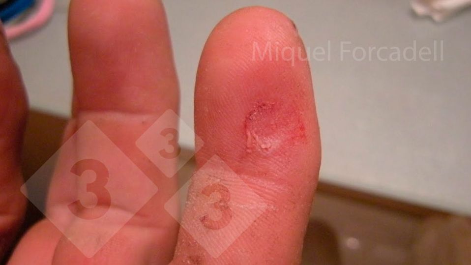 Los peque&ntilde;os y afilados colmillos de los lechones pueden producir estas molestas heridas en los dedos de los operarios durante el limado de dientes.
