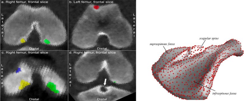 Figura 5. Derecha: Vistas frontal y lateral de cabezas de fémur que presentan lesiones en la superficie articular. Izquierda: Imagen tridimensional de la escápula.