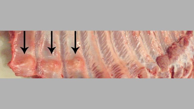 Multiple distal rib fractures with callus formation (arrows).