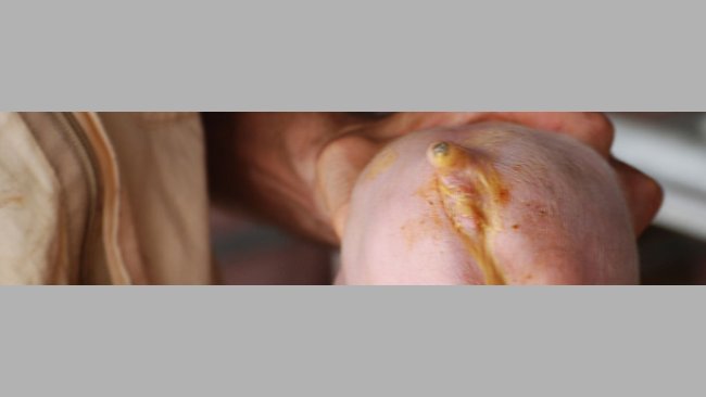 Diarrea neonatal causada por E. Coli. (Cortesía Dr Hector Patullo)