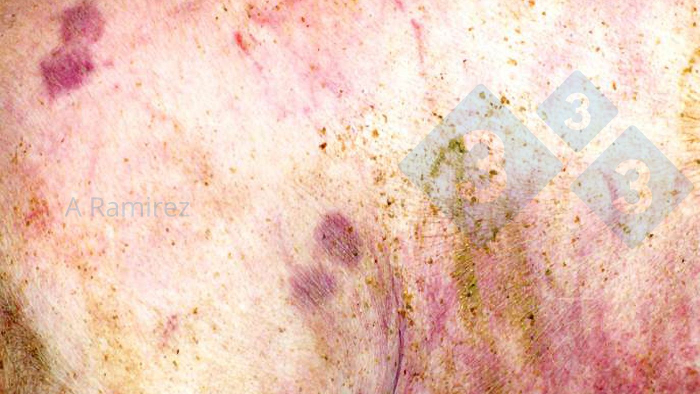 Figura 1.&nbsp;Lesi&oacute;n cut&aacute;nea casi patognom&oacute;nica en forma de diamante.
