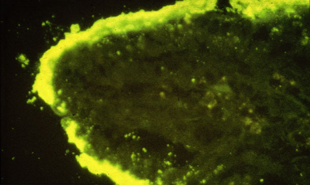 Col&ocirc;nias densas de E coli ligadas a vilosidades intestinais (IFA)
