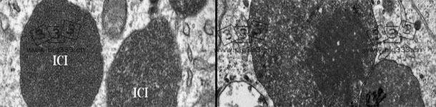 Electron micrograph of a lymph node from a PCV2-SD affected pig