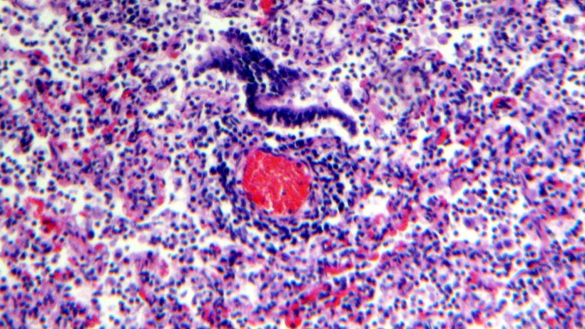Figure 5. Perivascular lymphocyte infiltration.