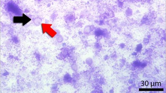 Kotausstrich mit Diff-Quick gefärbt. Der rote Pfeil zeigt auf die zentrale Vakuole. Der schwarze Pfeil zeigt auf den Zellkern