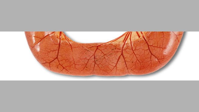 Sektion eines an ETEC erkrankten Schweins: aufgeblähte, stark gefüllte Dünndarmschlingen, mit wässrigem, gelblichen Kot gefüllt.