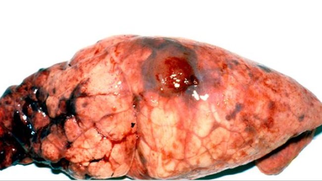 Chronische APP-Läsionen im Hauptlappen mit fokaler Pleuritis.