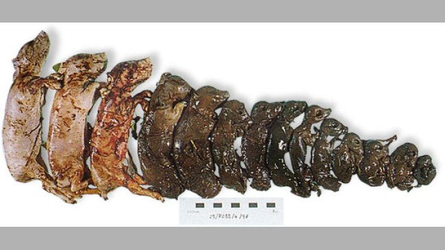 20100203_muerte_fetal_progresiva