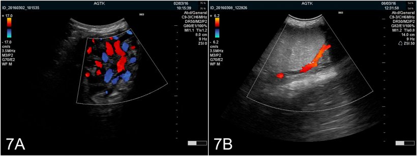 Figura 7:Im&aacute;genes del test&iacute;culo&nbsp;obtenidas mediante ultrasonograf&iacute;a&nbsp;Doppler color. A) Vasos del cord&oacute;n esperm&aacute;tico. B) Arteria testicularis
