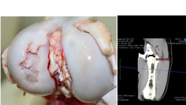 Vista macroscópica de la articulación de la rodilla con una lesión severa de osteocondrosis en el cóndilo lateral del fémur.