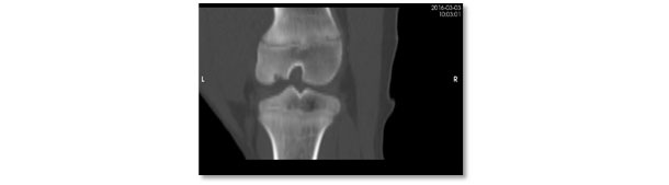 Vista de la misma lesi&oacute;n por tomograf&iacute;a computerizada. Lesi&oacute;n severa de osteocondrosis con falta de osificaci&oacute;n en la regi&oacute;n subarticular del c&oacute;ndilo lateral fel f&eacute;mur.
