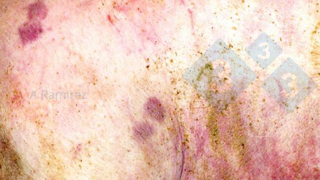 Figura 1. Lesión cutánea casi patognomónica en forma de diamante.