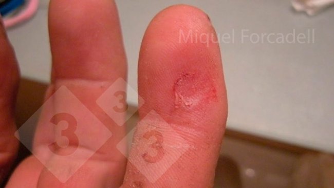 Los pequeños y afilados colmillos de los lechones pueden producir estas molestas heridas en los dedos de los operarios durante el limado de dientes.
