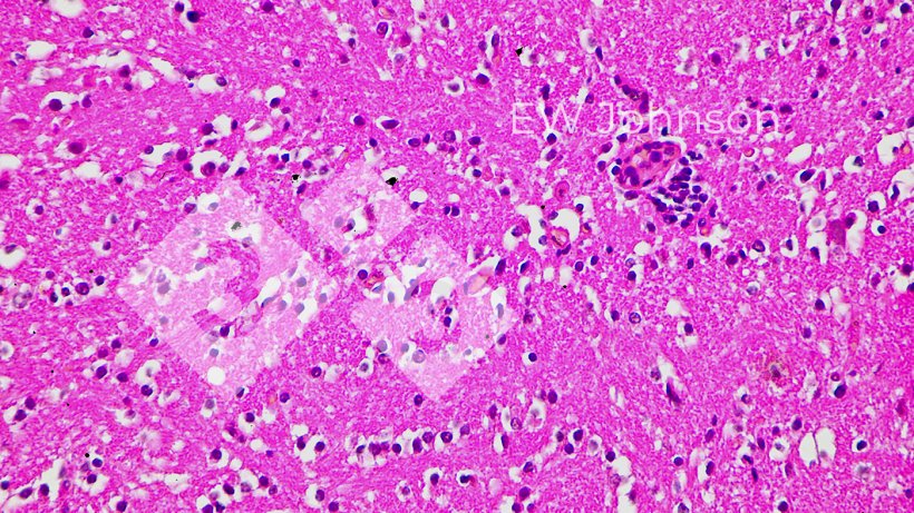 Figura 4.&nbsp;Encefalitis cerebral con vasculitis, satelitosis y neuronofagia.
