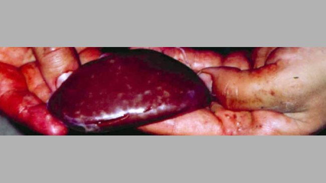 Nefritis