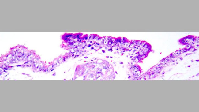Necrosis coagulativa en trofoblastos. Tinción hematoxilina-eosina.
