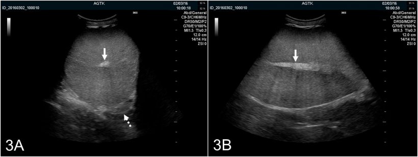 Figura 3:&nbsp;Im&aacute;genes ultrasonogr&aacute;ficas del test&iacute;culo de un verraco explorado transversalmente (A) y longitudinalmente (B). El rete testis se representa como una mancha hiperecog&eacute;nica en el centro del test&iacute;culo (flecha s&oacute;lida). El par&eacute;nquima testicular presenta ecog&eacute;nicidad media y de ecotextura homog&eacute;nea. La imagen transversal tambi&eacute;n proporciona una visualizaci&oacute;n &oacute;ptima del corpus epididimal (flecha punteada), que es normalmente de apariencia ultrasonogr&aacute;fica similar a la del test&iacute;culo.
