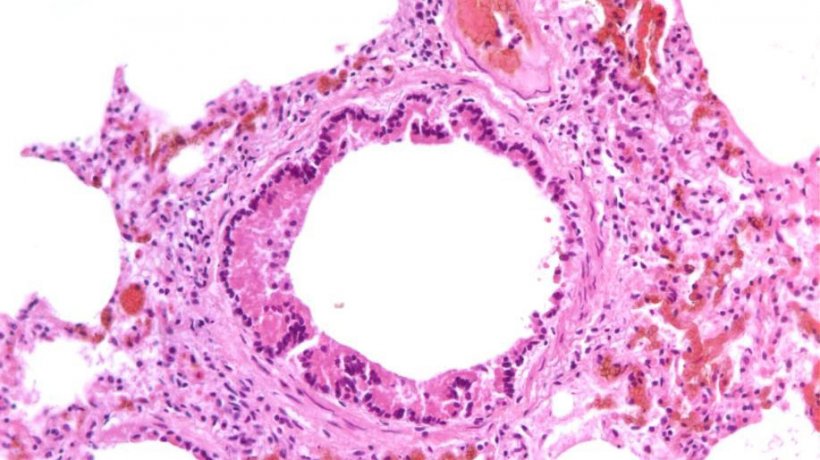 Figura 5: Bronquiolitis necrotizante causada por la infecci&oacute;n por SIV.
