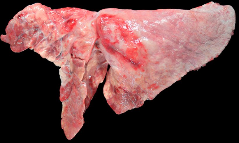 Figura 5: Pulm&oacute;n de un cerdo coinfectado con M. hyopneumoniae y A. pleuropneumoniae. &Aacute;reas de consolidaci&oacute;n craneoventrales de color marr&oacute;n-rojizo, provocada por la infecci&oacute;n por M. hyopneumoniae, y una lesi&oacute;n ovalada con fibrosis pleural y zonas hemorr&aacute;gicas en l&oacute;bulo diafragm&aacute;tico, que se corresponder&iacute;a a la cronicidad de un foco de necrosis producido por A. pleuropneumoniae.
