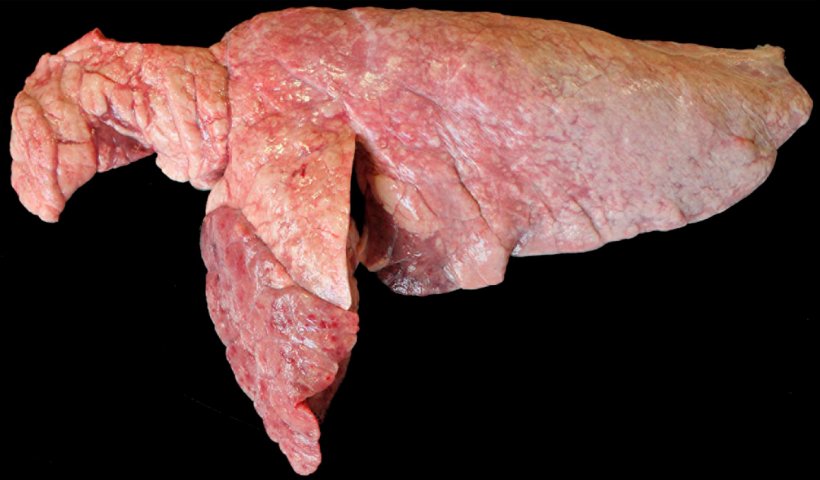 Figura 6. Pulm&oacute;n de un cerdo coinfectado con M. hyopneumoniae y P. multocida. &Aacute;reas de consolidaci&oacute;n craneoventrales de color marr&oacute;n-rojizo sobreelevadas con respecto al resto del par&eacute;nquima pulmonar que se corresponder&iacute;a a una lesi&oacute;n por P. multocida. En el l&oacute;bulo craneal y borde craneoventral del l&oacute;bulo caudal se observan &aacute;reas rojizas de consolidaci&oacute;n y de aspecto deprimido, que se corresponden con lesiones por M. hyopneumoniae.
