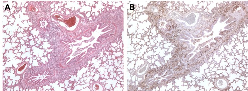 Figura 3. Pulm&oacute;n de un cerdo coinfectado por M. hyopneumoniae y PCV2. A: &Aacute;rea de hiperplasia linfoide peribronquiolar causada por M. hyopneumoniae. B: Gran cantidad de ant&iacute;geno de PCV2 en esa misma &aacute;rea de hiperplasia linfoide.
