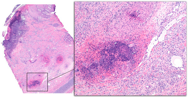 Ear tip biopsy from a chronically affected pig. Epidermal changes include ulceration with subjacent inflammation, serocellular crust formation, and acanthosis of the epidermis. The deep dermis is expanded by granulation tissue and hemorrhage.Deep dermal vessels are disrupted by thrombosis and vasculitis