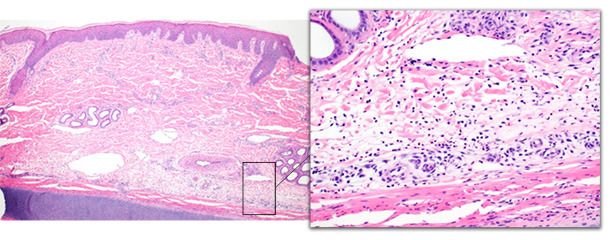 Ear tip biopsy from an acutely affected pig. The deep dermis is expanded by edema and moderate numbers of neutrophils with minimal epidermal changes.