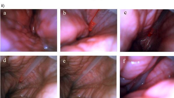 Post-cervical insemination seen from inside the uterus