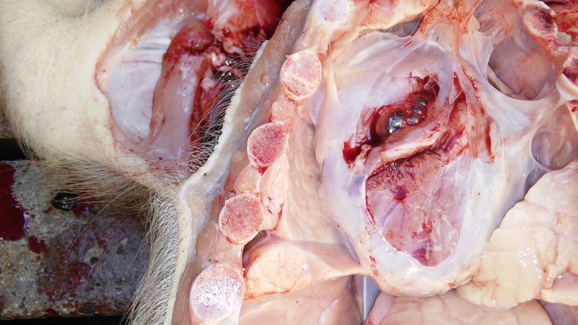 Ryc 5. Pericarditis (zapalenie osierdzia).
