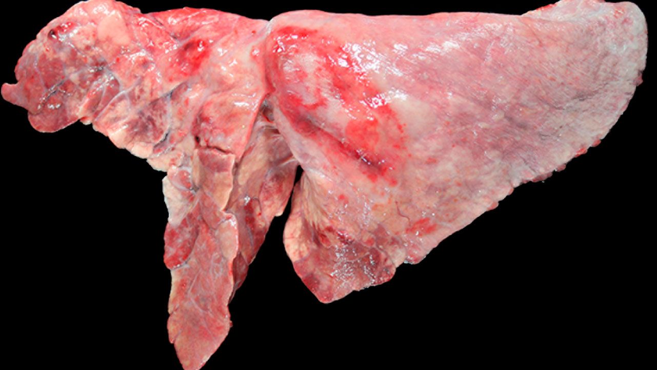 Ryc 5: Koinfekcja M. hyopneumoniae i A. pleuropneumoniae w płucach świń. Doczaszkowo-środkowe obszary konsolidacji o czerwono-brązowym zabarwieniu, wywołane zakażeniem M. hyopneumoniae oraz owalna zmiana ze zwł&oacute;knieniem opłucnej i krwotoczną okolicą w płacie przeponowym, odpowiadająca przewlekłemu stadium po powstaniu martwicy wywołanej przez A. pleuropneumoniae.
