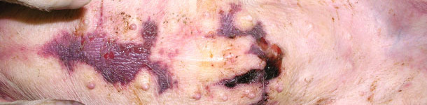 Accumulation of fluid beneath the skin in the sternum area