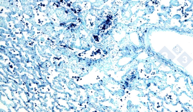 Ryc. 4. Hybrydyzacja in situ w celu wykrycia cirkowirusa świń 2 (PCV-2) w płucach dotkniętych śródmiąższowym zapaleniem płuc.