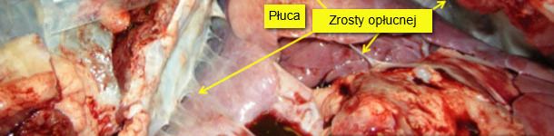 Pericarditis