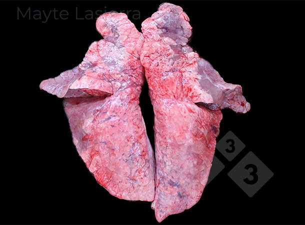 Tiến triển của vi&ecirc;m phế quản phổi
