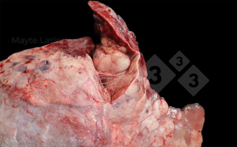 Vi&ecirc;m m&agrave;ng phổi v&ugrave;ng r&igrave;a
