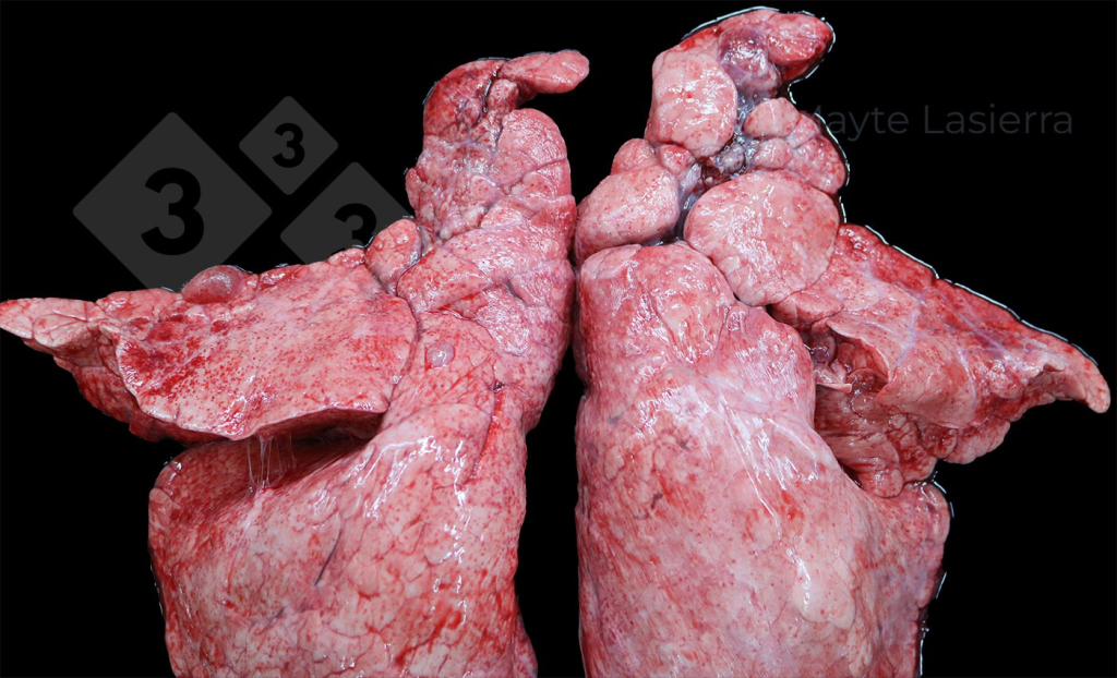 Vi&ecirc;m m&agrave;ng phổi v&ugrave;ng r&igrave;a
