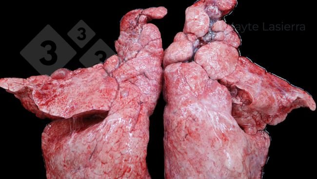 Viêm màng phổi vùng rìa