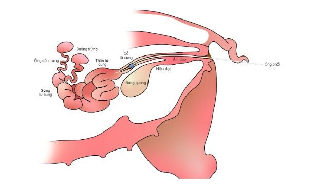 Hình 2. Trong phối tinh sau cổ tử cung, tinh dịch được bơm vào trong thân tử cung, qua cổ tử cung.